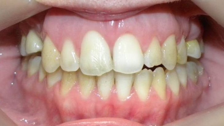 Frontal (Oclusión)