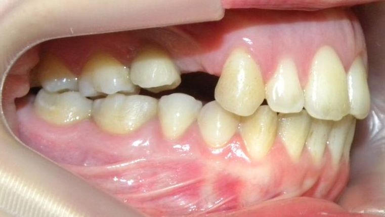 Lateral Derecha