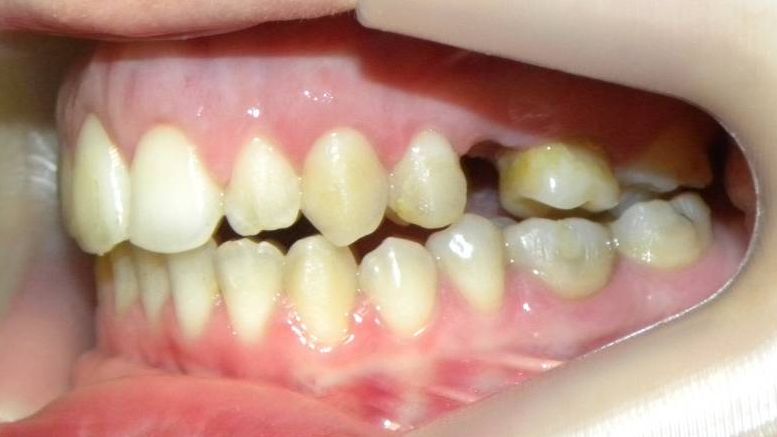Lateral Izquierda