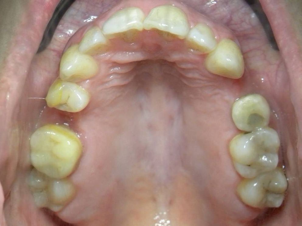 Oclusal Superior