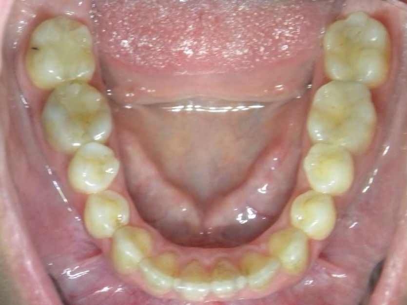 Oclusal Inferior