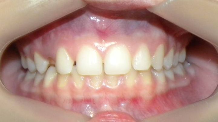 Frontal (Oclusión)
