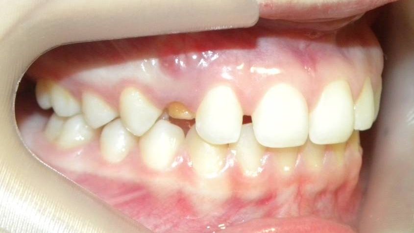 Lateral Derecha
