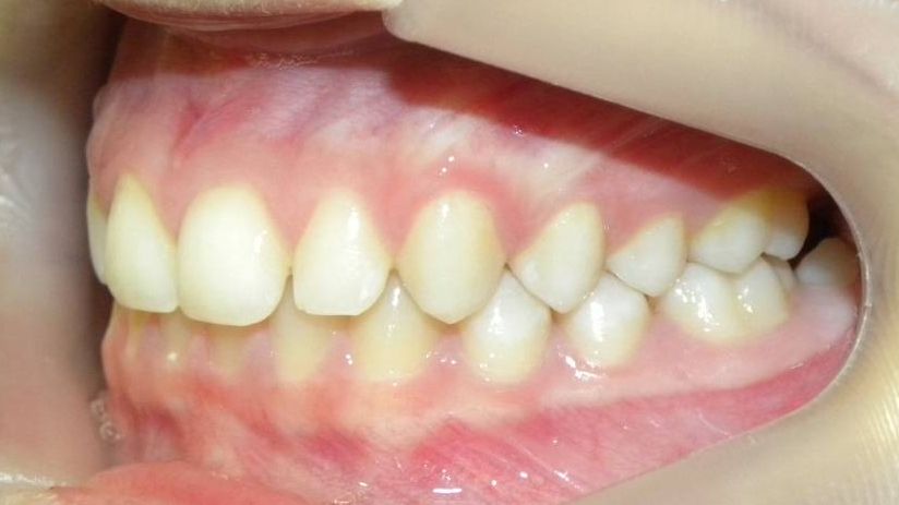 Lateral Izquierda