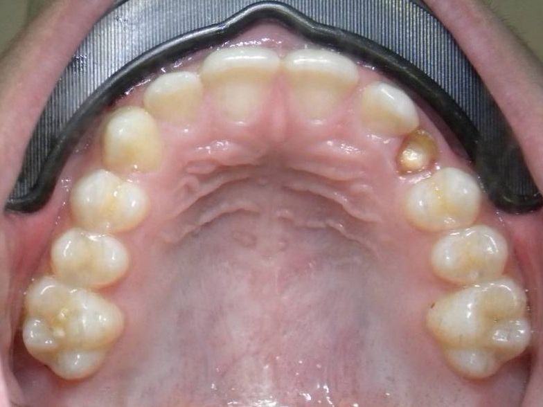 Oclusal Superior