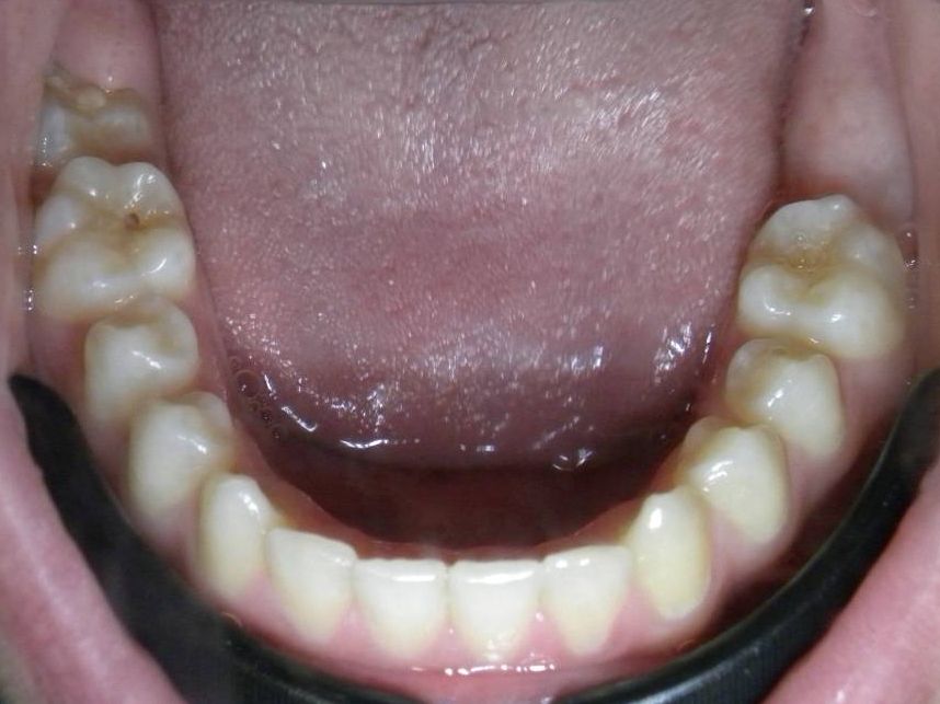 Oclusal Inferior