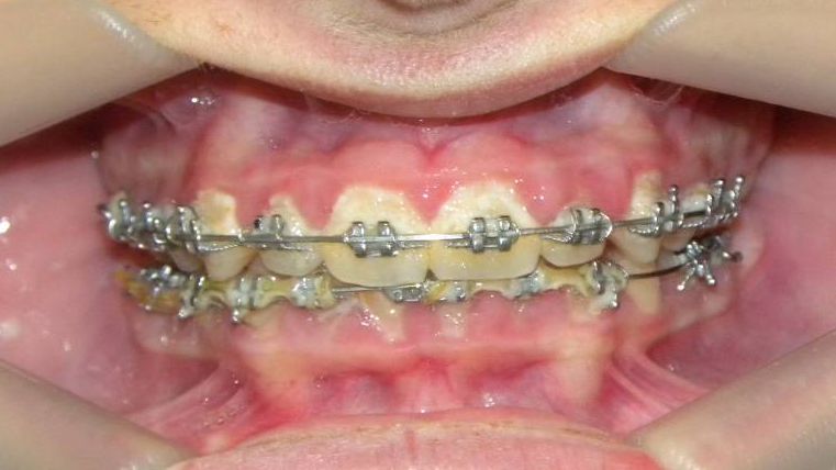 Frontal (Oclusión)