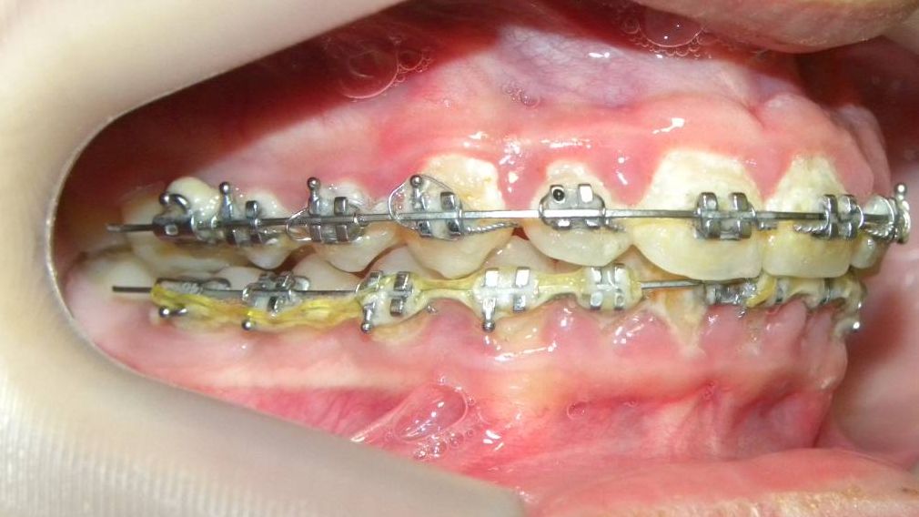 Lateral Derecha