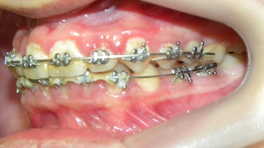 Lateral Izquierda