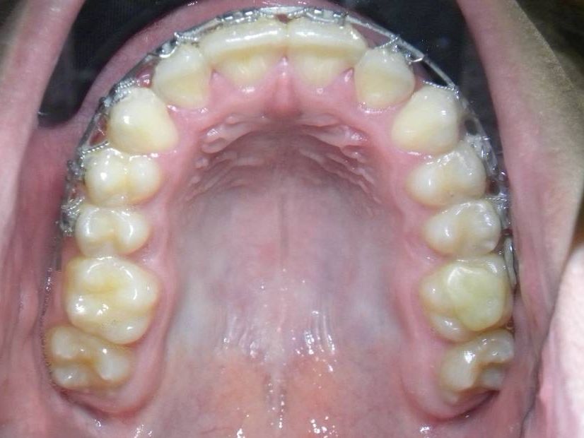 Oclusal Superior