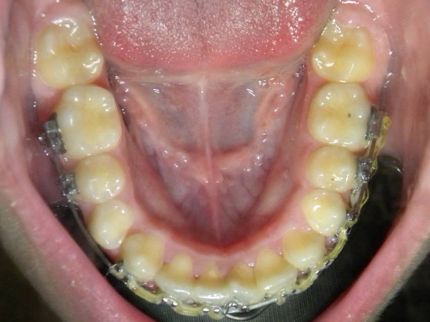 Oclusal Inferior