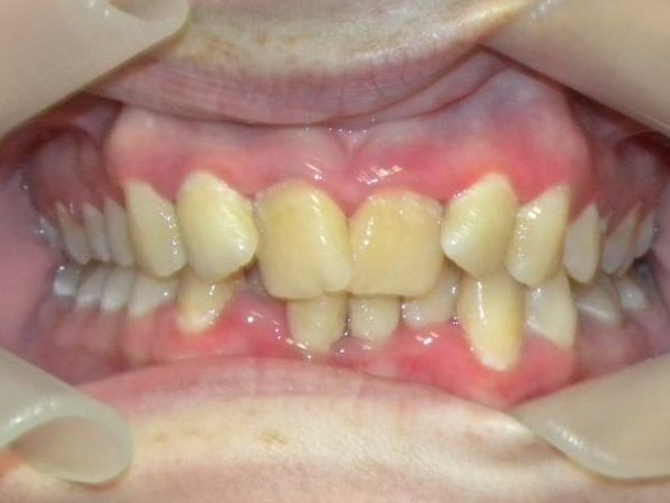 Frontal (Oclusión)