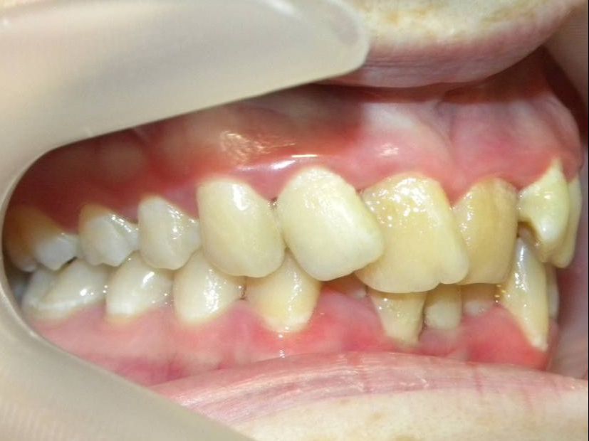 Lateral Derecha