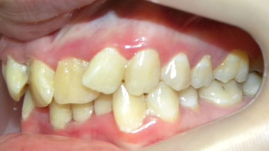 Lateral Izquierda