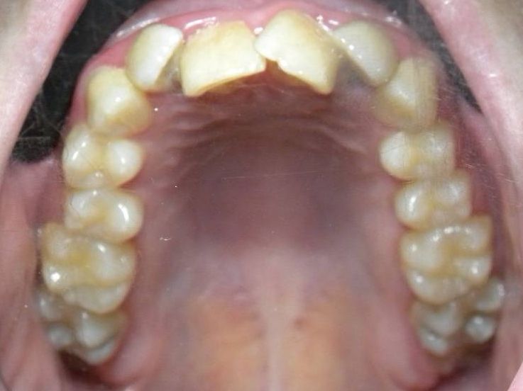 Oclusal Superior