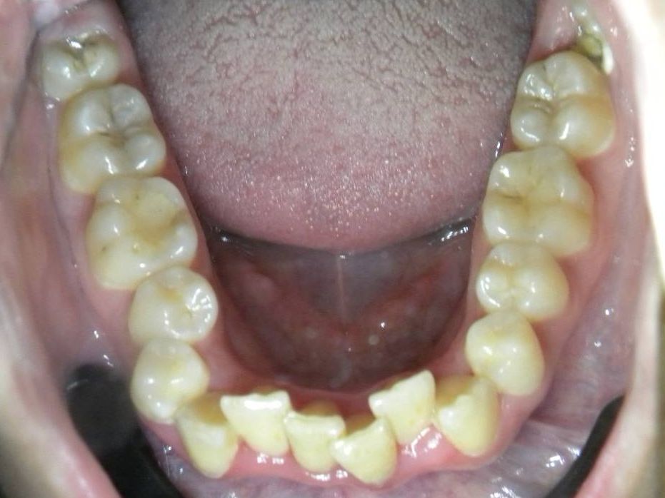 Oclusal Inferior
