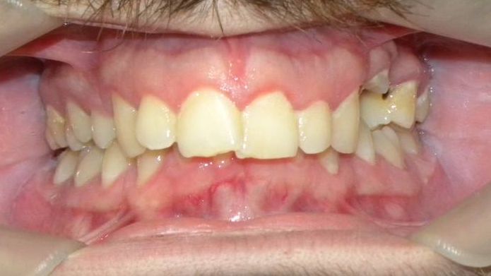 Frontal (Oclusión)