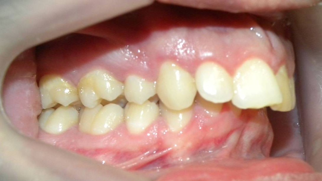 Lateral Derecha