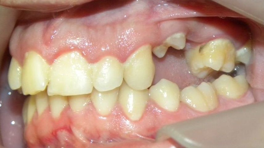 Lateral Izquierda