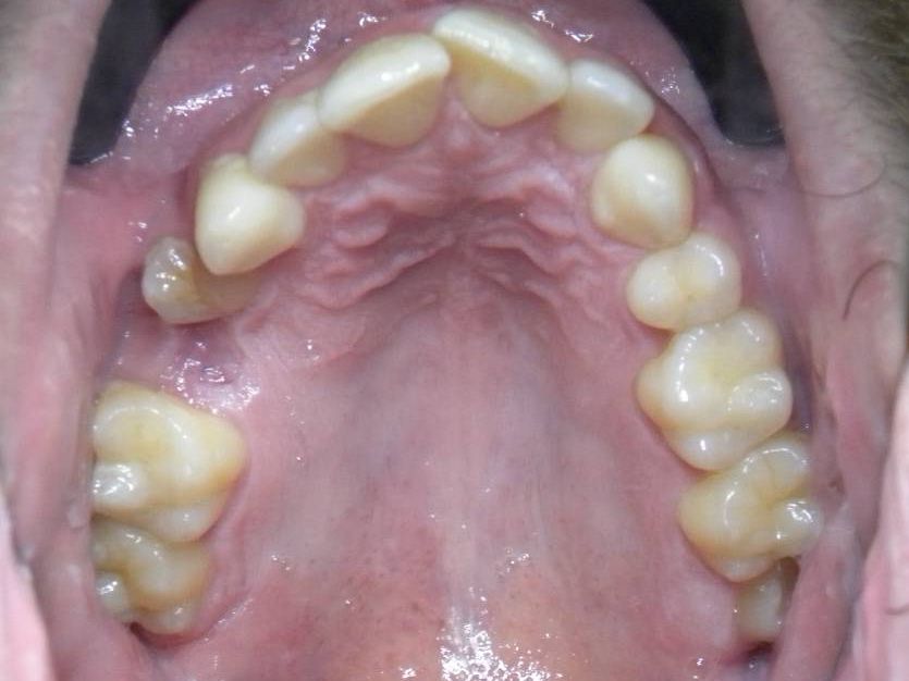 Oclusal Superior