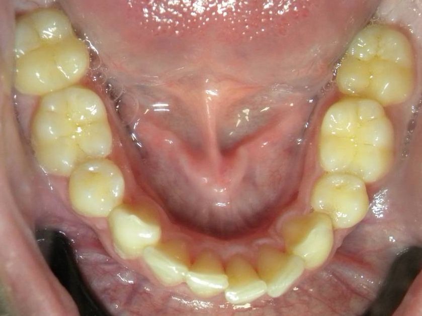 Oclusal Inferior