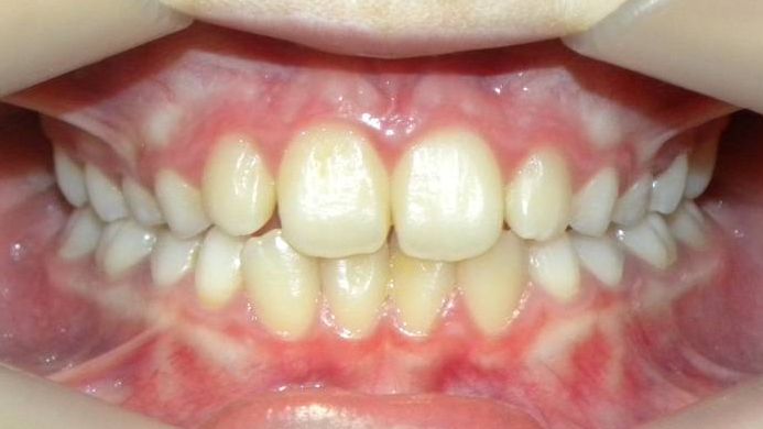 Frontal (Oclusión)