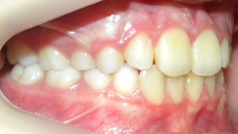Lateral Derecha