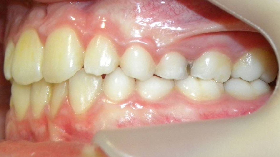 Lateral Izquierda