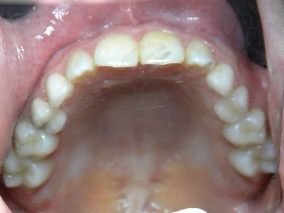 Oclusal Superior