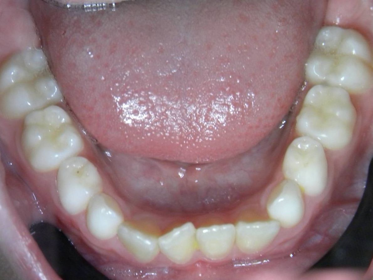 Oclusal Inferior