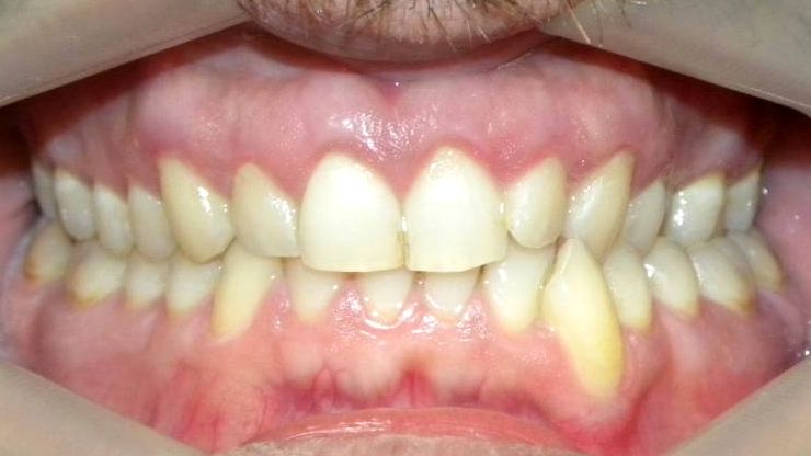 Frontal (Oclusión)