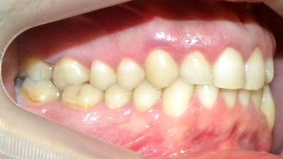 Lateral Derecha