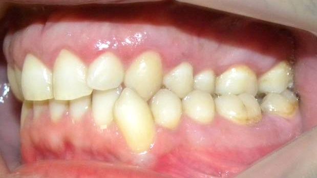 Lateral Izquierda