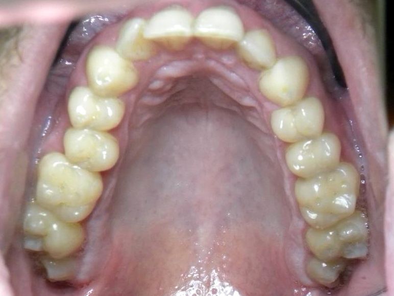 Oclusal Superior
