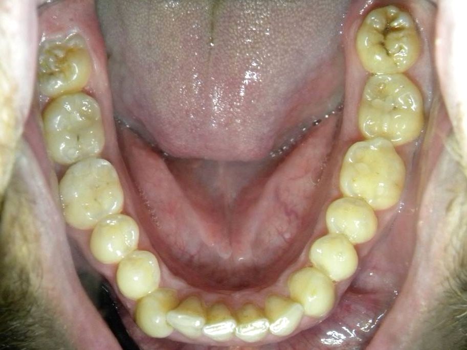 Oclusal Inferior