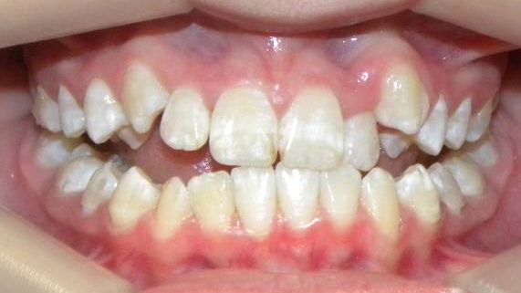 Frontal (Oclusión)