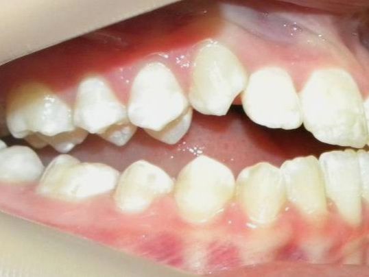 Lateral Derecha