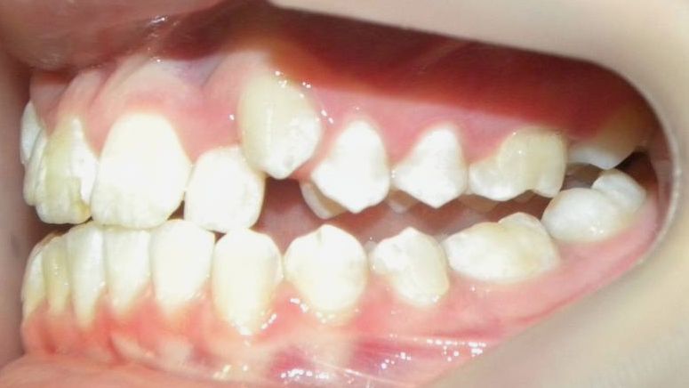 Lateral Izquierda