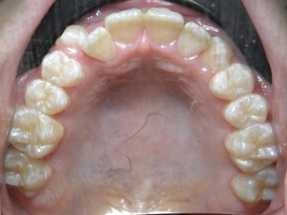 Oclusal Superior