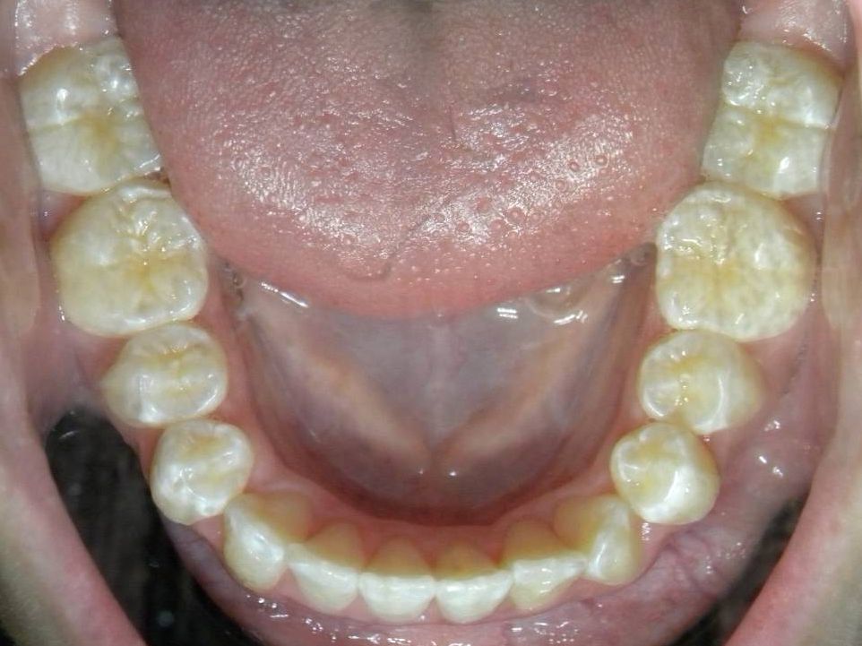 Oclusal Inferior