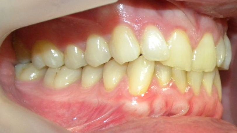 Lateral Derecha