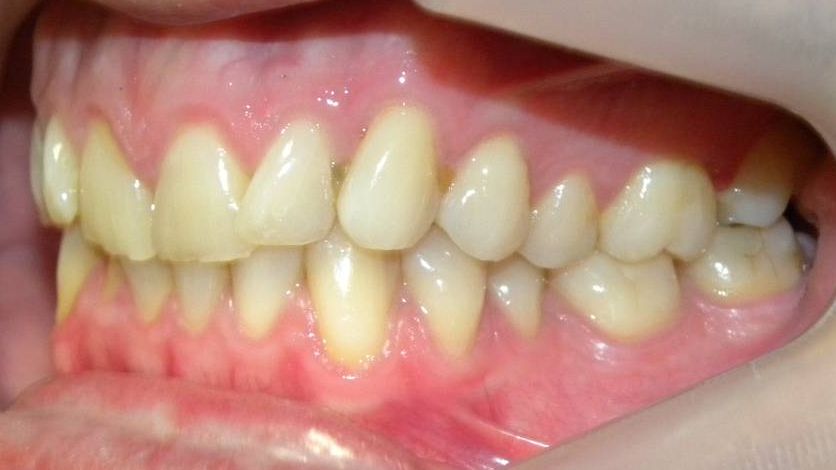 Lateral Izquierda