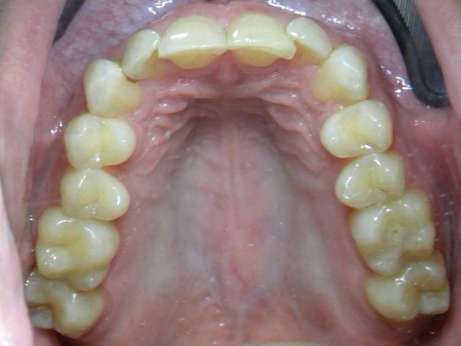 Oclusal Superior
