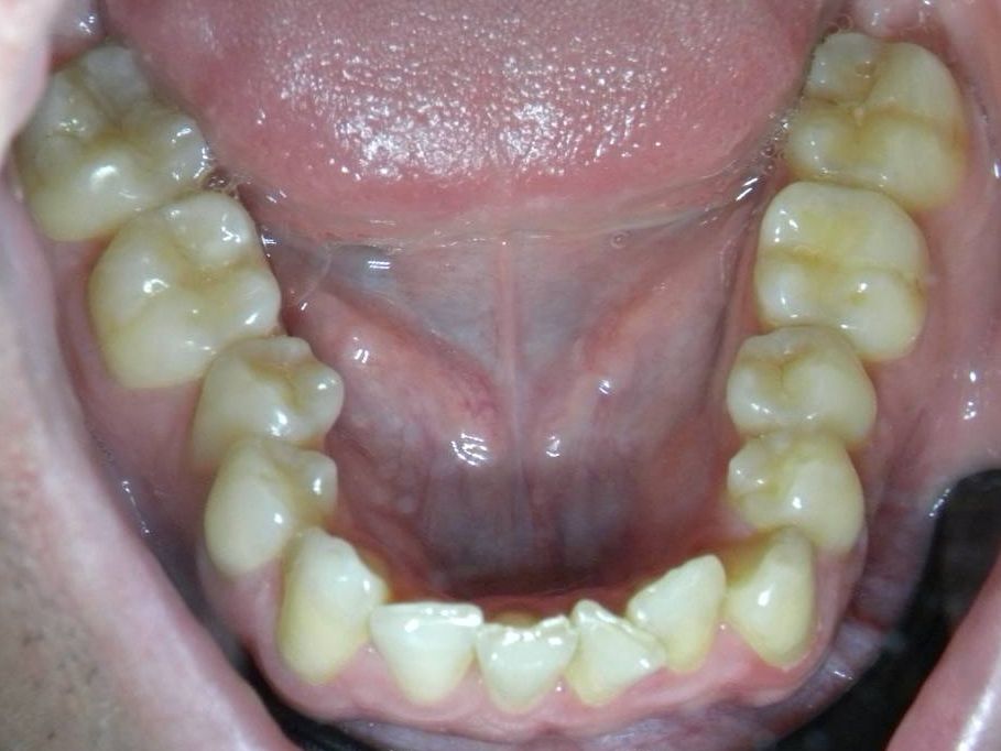 Oclusal Inferior