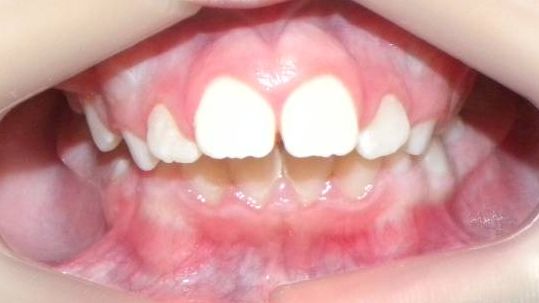Frontal (Oclusión)
