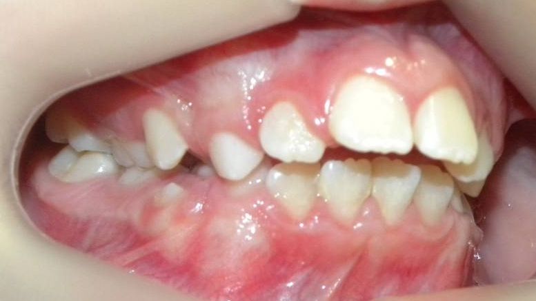 Lateral Derecha