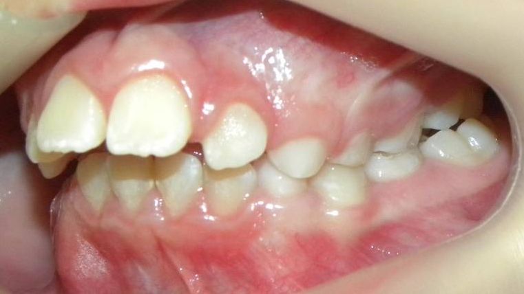 Lateral Izquierda