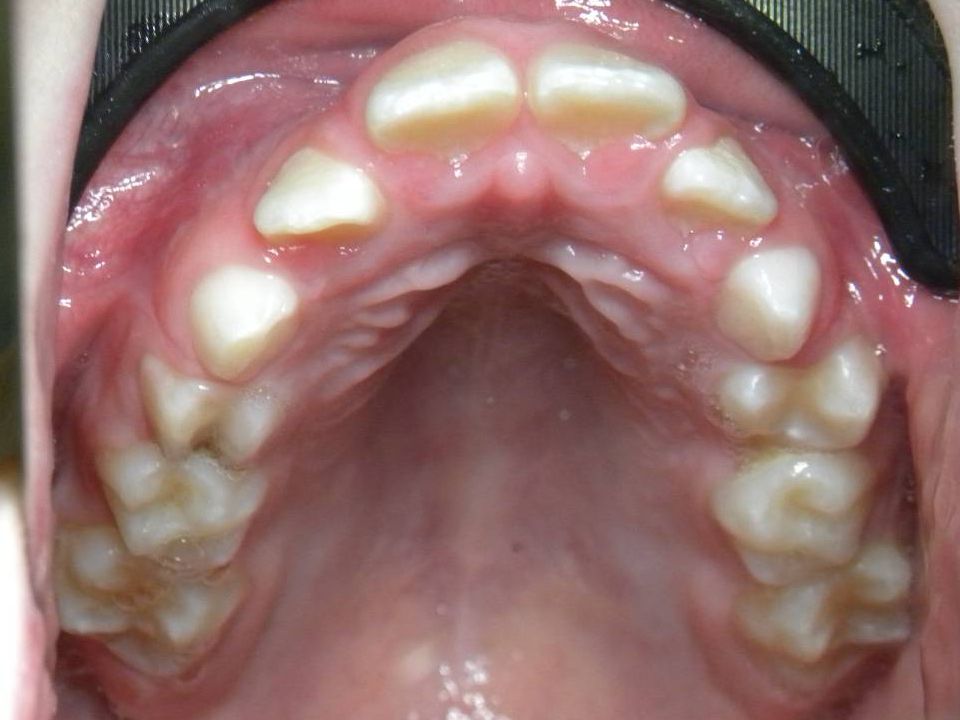 Oclusal Superior