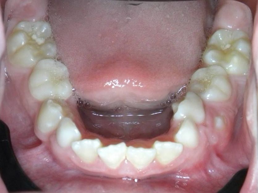 Oclusal Inferior