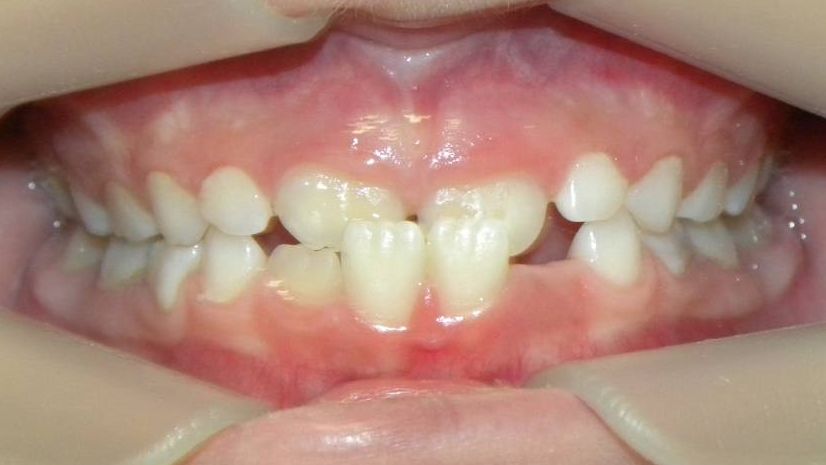 Frontal (Oclusión)